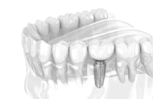 Имплантация Dentium за два приема со скидкой