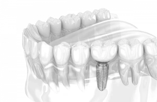 Имплантация Dentium за два приема со скидкой